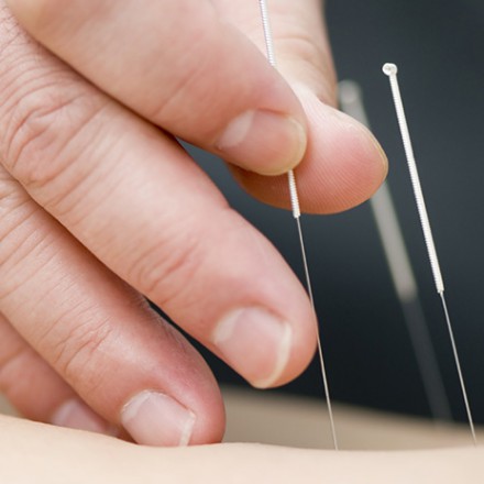 Dry Needling Dry Needling